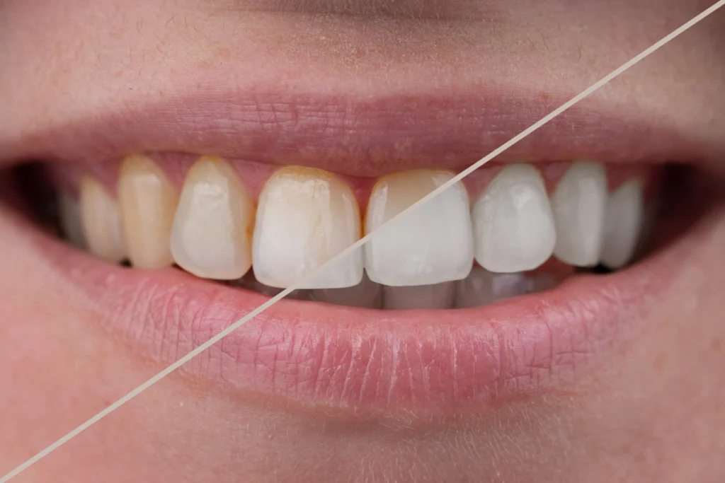 adobestock Éclaircissement dentaire Dentistes à Metz | Esthétique dentaire | Cabinet dentaire des Ormes
