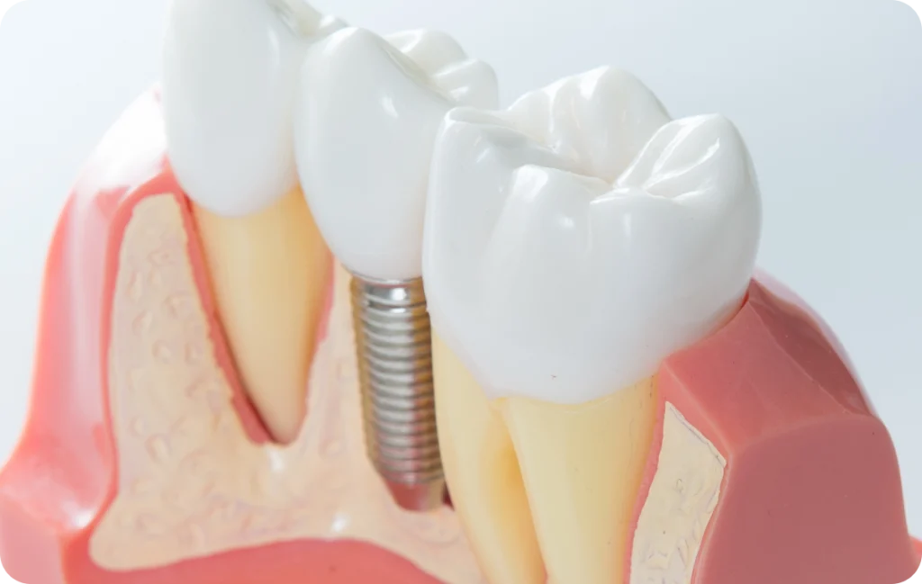 implant dentaire metz Soins dentaries Dentistes à Metz | Esthétique dentaire | Cabinet dentaire des Ormes