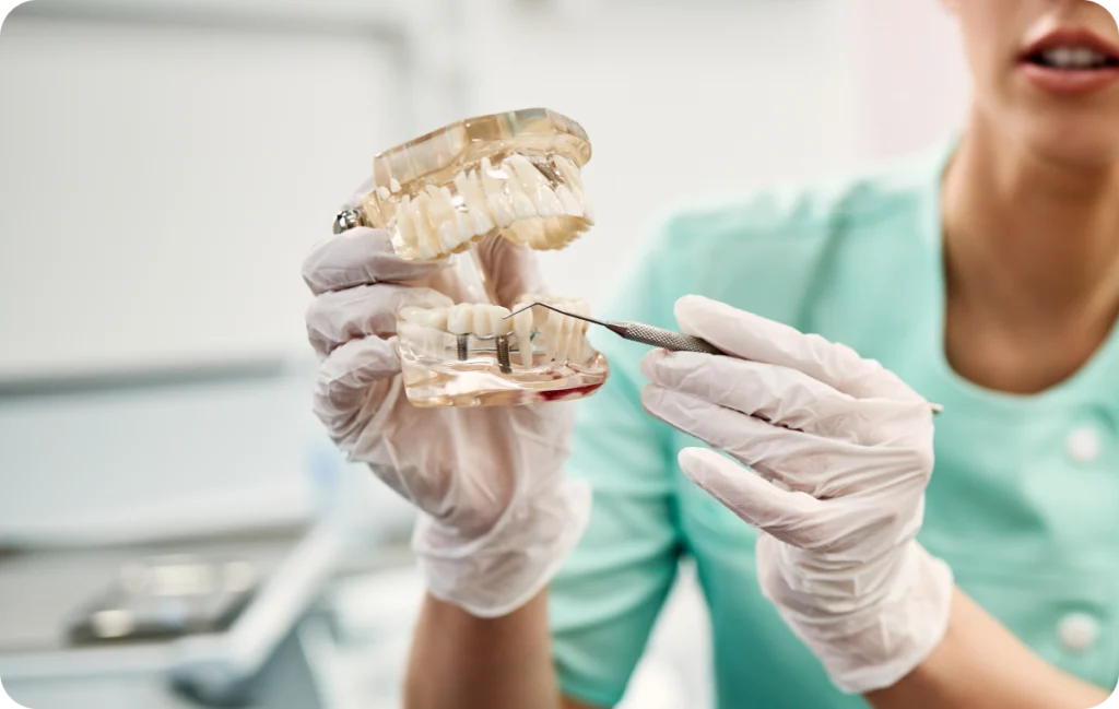Implants dentaires