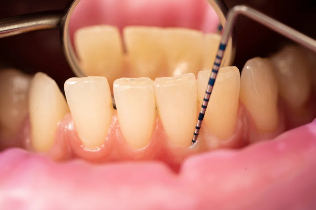 Soins des gencives cliniques